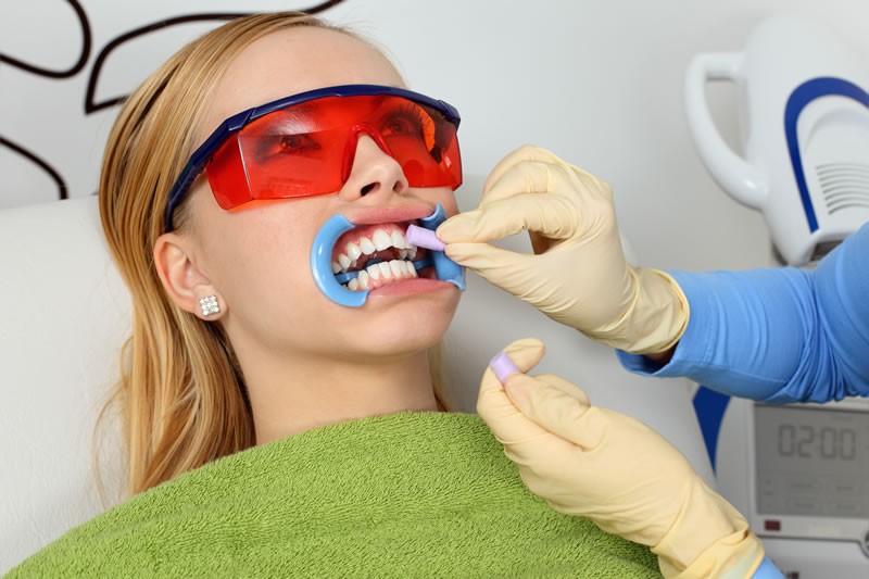 Izbjeljivanje zubi